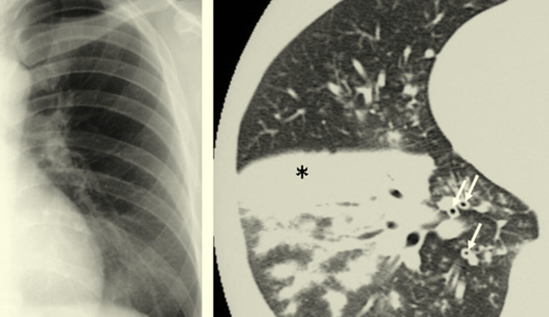 Bacteria called Mycoplasma pneumoniae can cause respiratory tract infections.