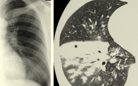 Bacteria called Mycoplasma pneumoniae can cause respiratory tract infections.